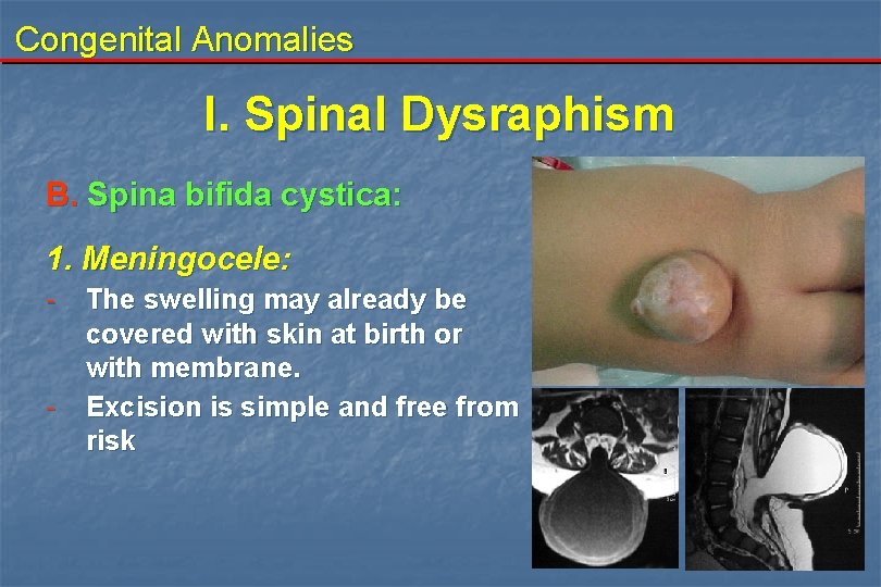 Congenital Anomalies I. Spinal Dysraphism B. Spina bifida cystica: 1. Meningocele: - - The