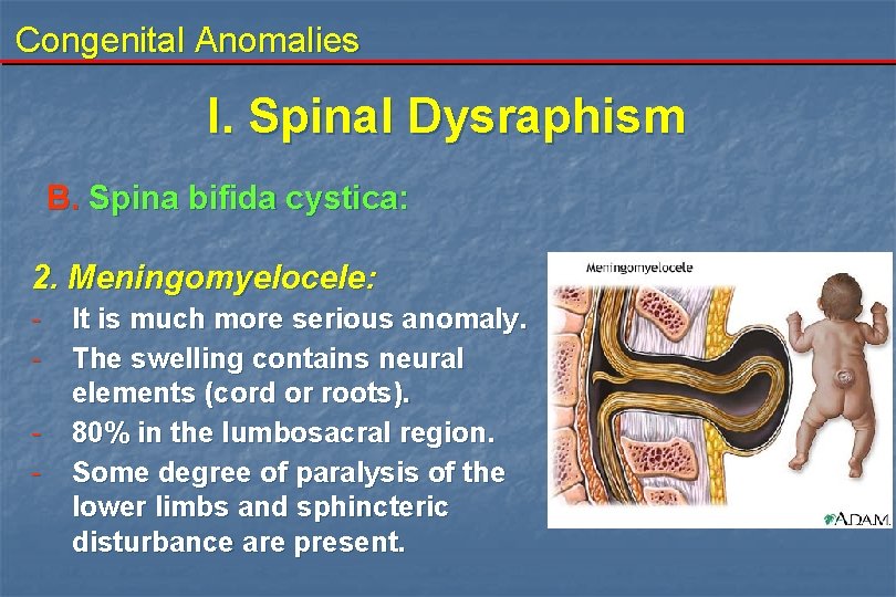 Congenital Anomalies I. Spinal Dysraphism B. Spina bifida cystica: 2. Meningomyelocele: - It is Congenital Anomalies I. Spinal Dysraphism B. Spina bifida cystica: 2. Meningomyelocele: - It is