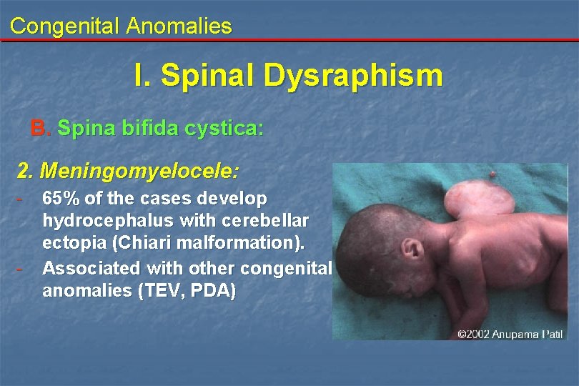 Congenital Anomalies I. Spinal Dysraphism B. Spina bifida cystica: 2. Meningomyelocele: - - 65% Congenital Anomalies I. Spinal Dysraphism B. Spina bifida cystica: 2. Meningomyelocele: - - 65%