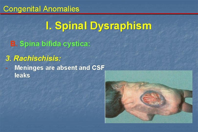 Congenital Anomalies I. Spinal Dysraphism B. Spina bifida cystica: 3. Rachisis: - Meninges are