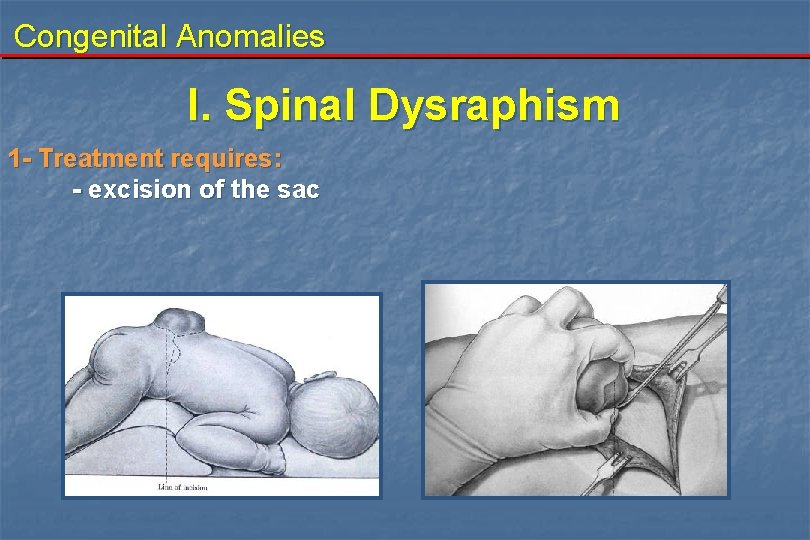 Congenital Anomalies I. Spinal Dysraphism 1 - Treatment requires: - excision of the sac