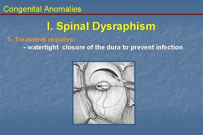 Congenital Anomalies I. Spinal Dysraphism 1 - Treatment requires: - watertight closure of the