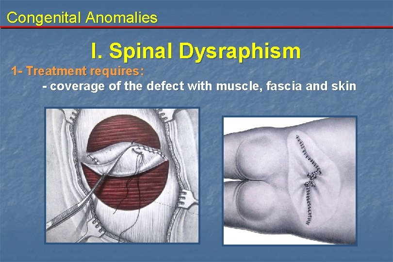 Congenital Anomalies I. Spinal Dysraphism 1 - Treatment requires: - coverage of the defect