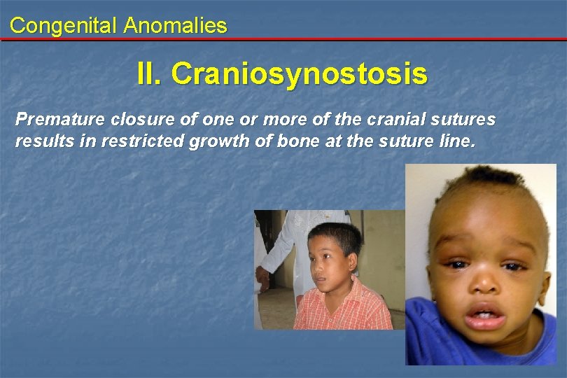 Congenital Anomalies II. Craniosynostosis Premature closure of one or more of the cranial sutures