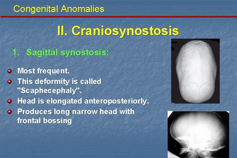 Congenital Anomalies II. Craniosynostosis 1. Sagittal synostosis: Most frequent. This deformity is called "Scaphecephaly".