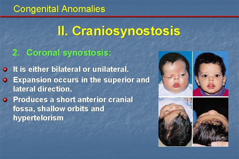 Congenital Anomalies II. Craniosynostosis 2. Coronal synostosis: It is either bilateral or unilateral. Expansion Congenital Anomalies II. Craniosynostosis 2. Coronal synostosis: It is either bilateral or unilateral. Expansion