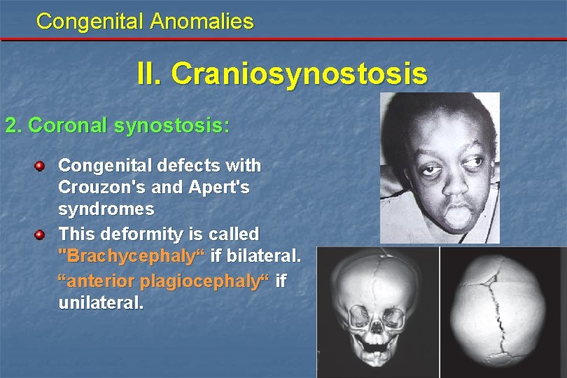 Congenital Anomalies II. Craniosynostosis 2. Coronal synostosis: Congenital defects with Crouzon's and Apert's syndromes Congenital Anomalies II. Craniosynostosis 2. Coronal synostosis: Congenital defects with Crouzon's and Apert's syndromes