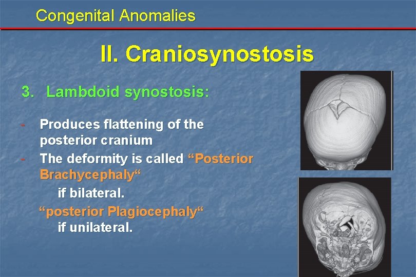 Congenital Anomalies II. Craniosynostosis 3. Lambdoid synostosis: - Produces flattening of the posterior cranium