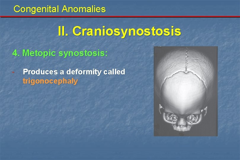 Congenital Anomalies II. Craniosynostosis 4. Metopic synostosis: - Produces a deformity called trigonocephaly 