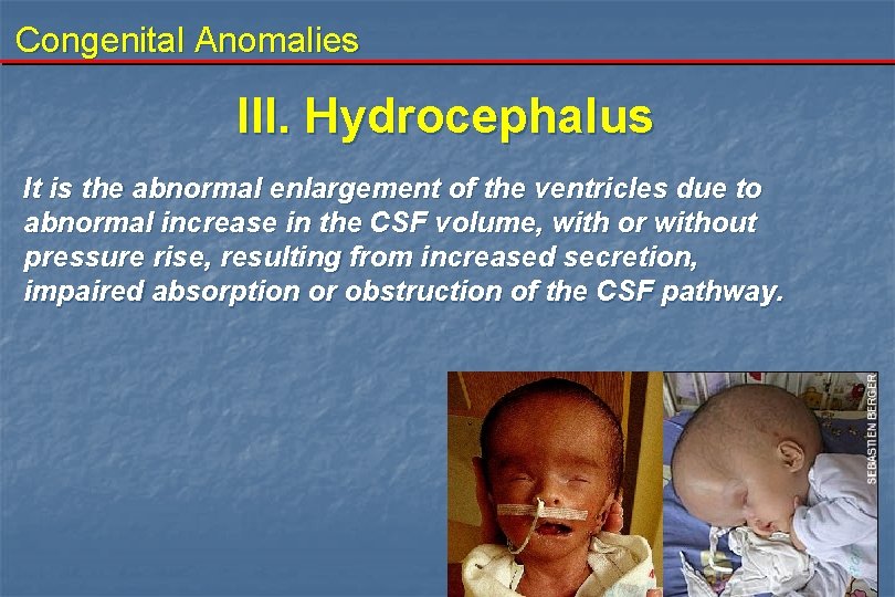 Congenital Anomalies III. Hydrocephalus It is the abnormal enlargement of the ventricles due to