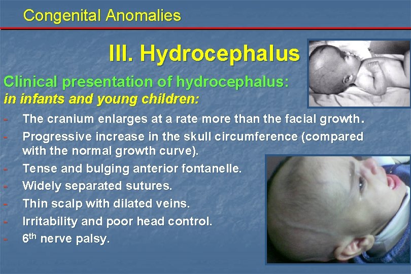 Congenital Anomalies III. Hydrocephalus Clinical presentation of hydrocephalus: in infants and young children: -