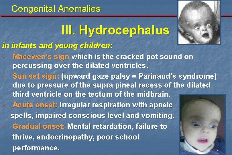 Congenital Anomalies III. Hydrocephalus in infants and young children: - Macewen’s sign which is