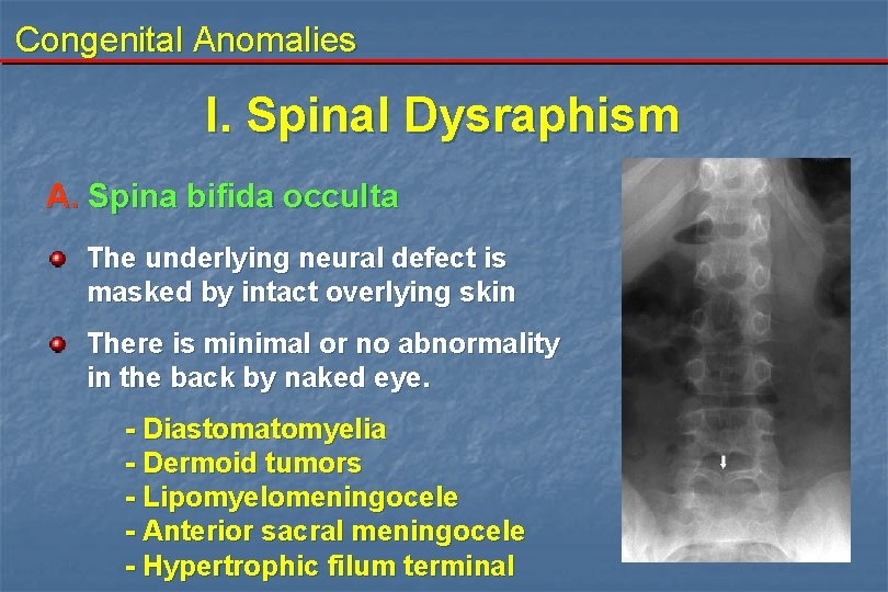 Congenital Anomalies I. Spinal Dysraphism A. Spina bifida occulta The underlying neural defect is Congenital Anomalies I. Spinal Dysraphism A. Spina bifida occulta The underlying neural defect is