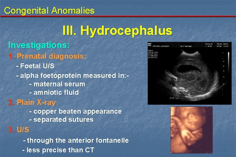 Congenital Anomalies III. Hydrocephalus Investigations: 1. Prenatal diagnosis: - Foetal U/S - alpha foetoprotein