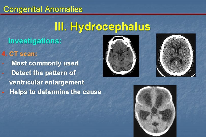 Congenital Anomalies III. Hydrocephalus Investigations: 4. CT scan: - Most commonly used - Detect