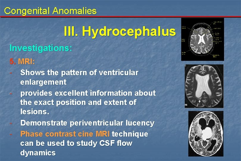 Congenital Anomalies III. Hydrocephalus Investigations: 5. MRI: - Shows the pattern of ventricular enlargement