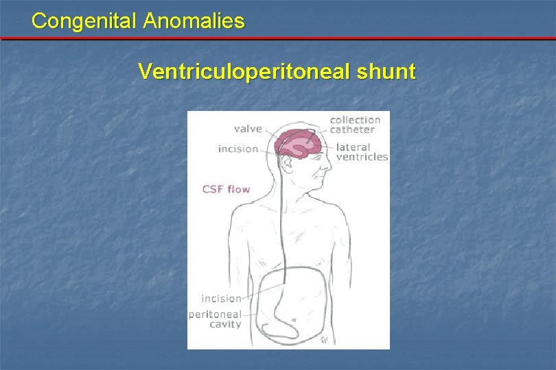 Congenital Anomalies Ventriculoperitoneal shunt 