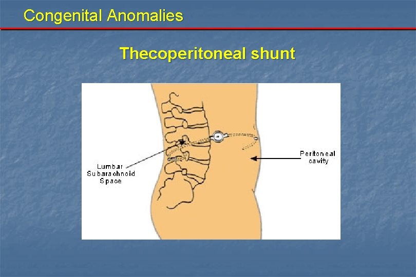 Congenital Anomalies Thecoperitoneal shunt 