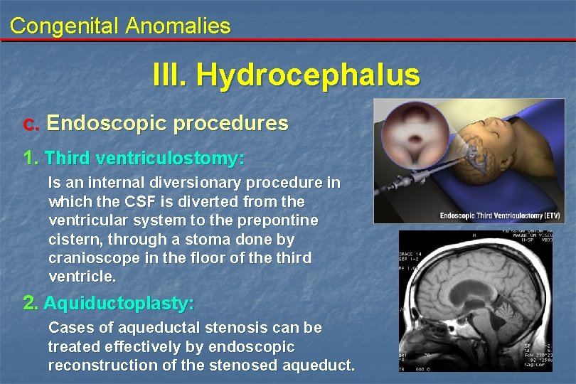 Congenital Anomalies III. Hydrocephalus c. Endoscopic procedures 1. Third ventriculostomy: Is an internal diversionary