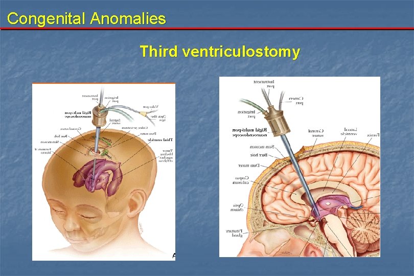 Congenital Anomalies Third ventriculostomy 