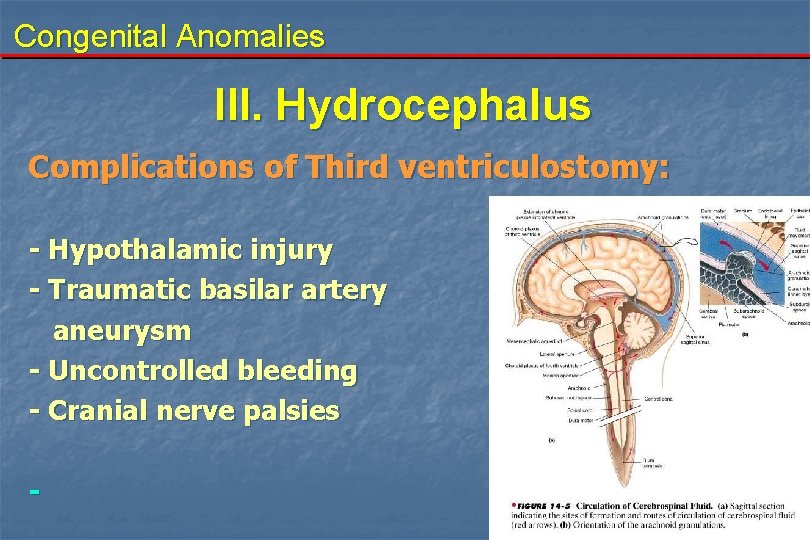 Congenital Anomalies III. Hydrocephalus Complications of Third ventriculostomy: - Hypothalamic injury - Traumatic basilar