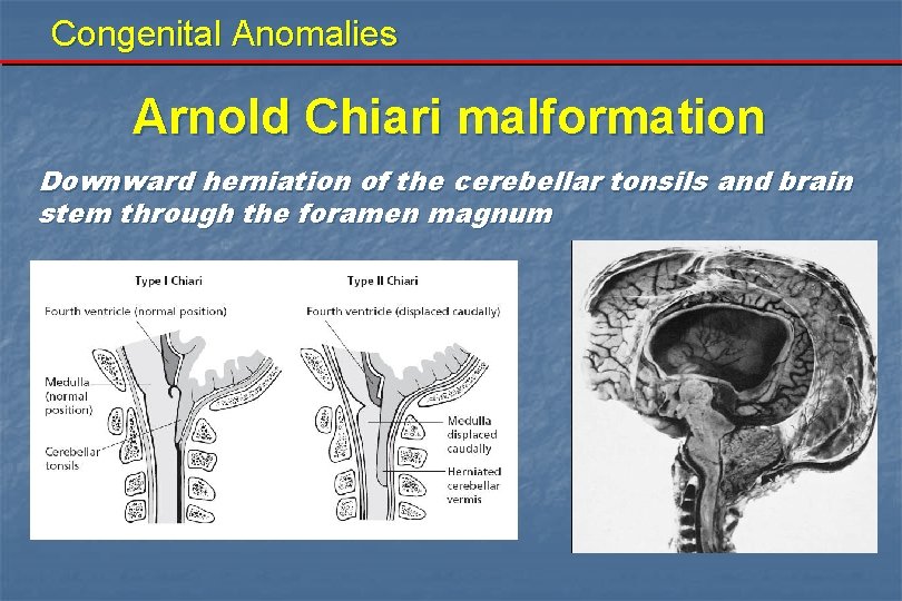 Congenital Anomalies Arnold Chiari malformation Downward herniation of the cerebellar tonsils and brain stem