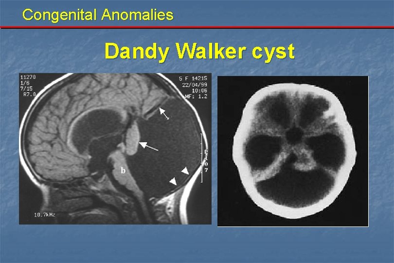 Congenital Anomalies Dandy Walker cyst 