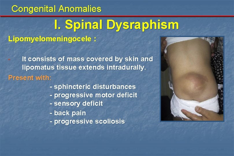 Congenital Anomalies I. Spinal Dysraphism Lipomyelomeningocele : - It consists of mass covered by