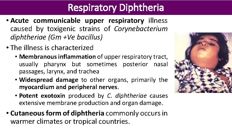 Respiratory Diphtheria • Acute communicable upper respiratory illness caused by toxigenic strains of Corynebacterium