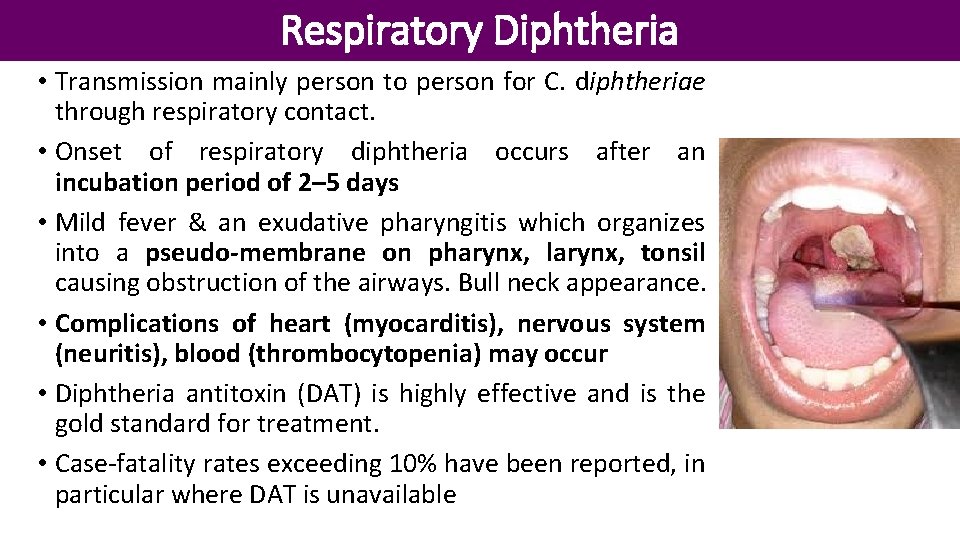 Respiratory Diphtheria • Transmission mainly person to person for C. diphtheriae through respiratory contact.