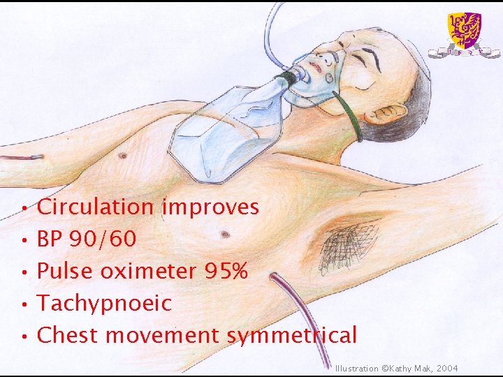 • Circulation improves • BP 90/60 • Pulse oximeter 95% • Tachypnoeic • • Circulation improves • BP 90/60 • Pulse oximeter 95% • Tachypnoeic •