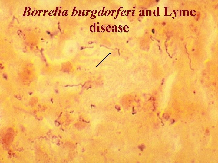 Borrelia burgdorferi and Lyme disease 16 