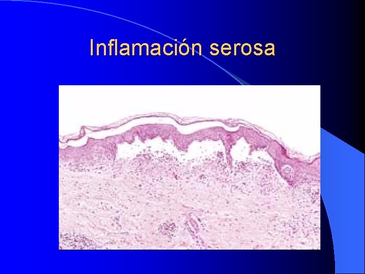 Inflamación serosa Inflamación serosa