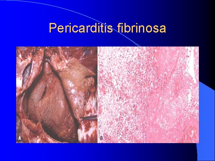 Pericarditis fibrinosa Pericarditis fibrinosa
