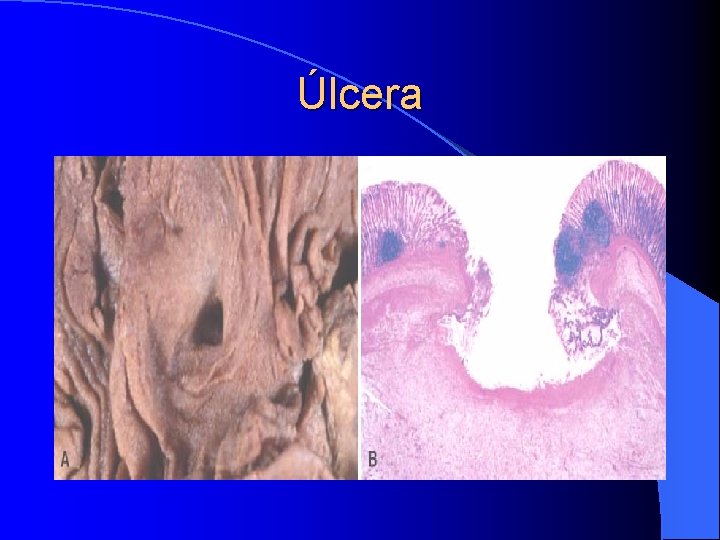 Úlcera Úlcera
