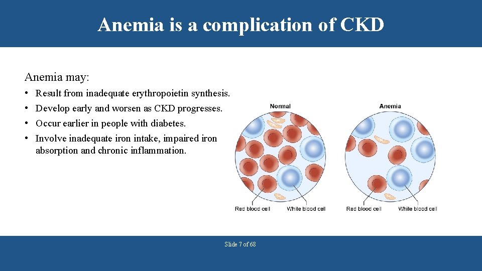 Anemia is a complication of CKD Anemia may: • • Result from inadequate erythropoietin