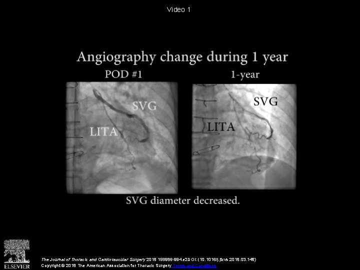 Video 1 The Journal of Thoracic and Cardiovascular Surgery 2018 156986 -994. e 2