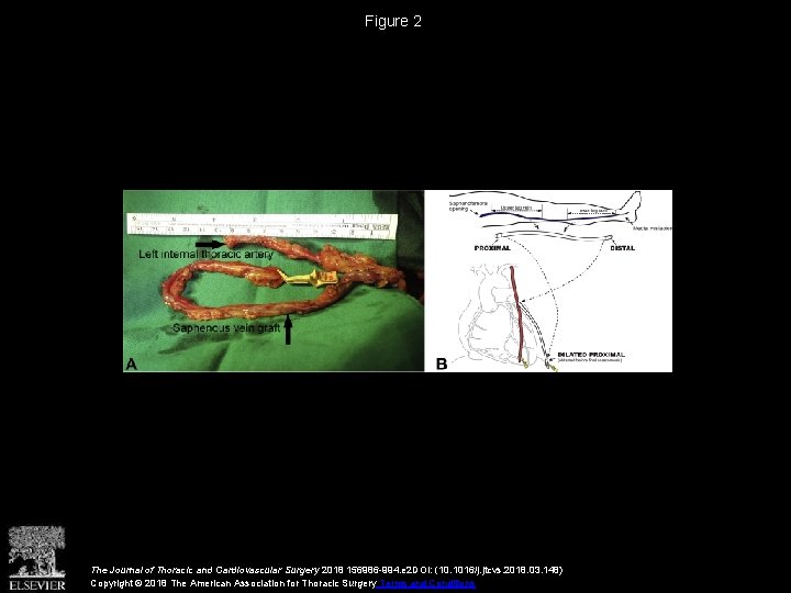 Figure 2 The Journal of Thoracic and Cardiovascular Surgery 2018 156986 -994. e 2