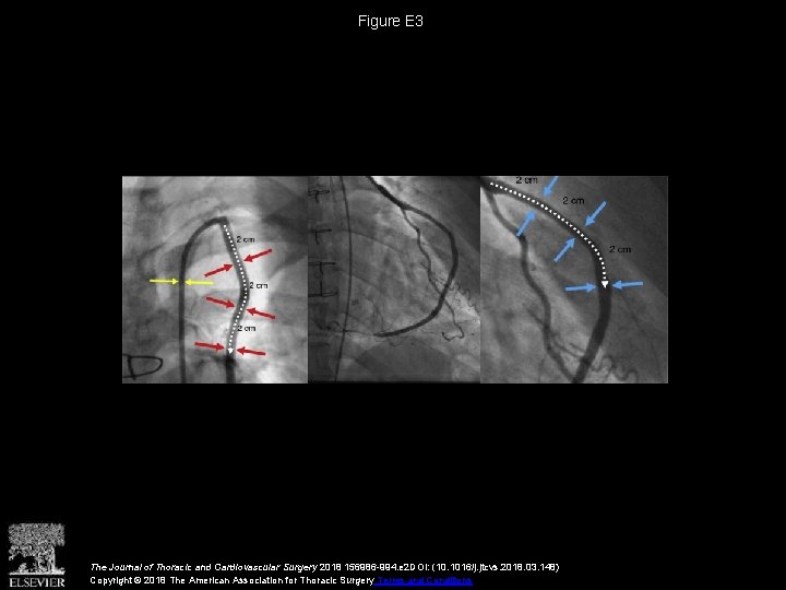 Figure E 3 The Journal of Thoracic and Cardiovascular Surgery 2018 156986 -994. e