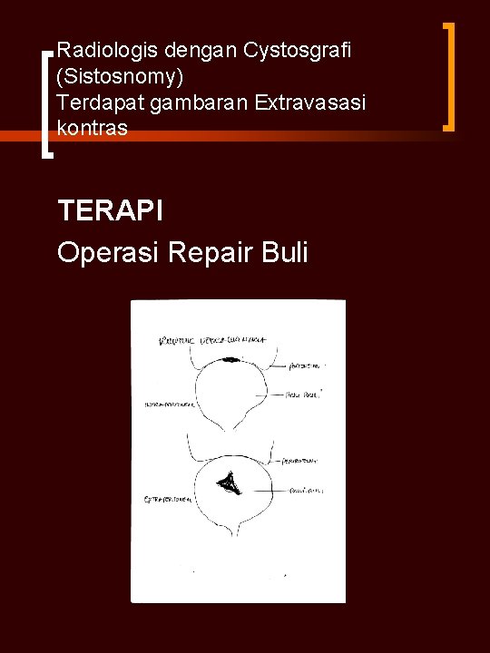 Radiologis dengan Cystosgrafi (Sistosnomy) Terdapat gambaran Extravasasi kontras TERAPI Operasi Repair Buli Radiologis dengan Cystosgrafi (Sistosnomy) Terdapat gambaran Extravasasi kontras TERAPI Operasi Repair Buli
