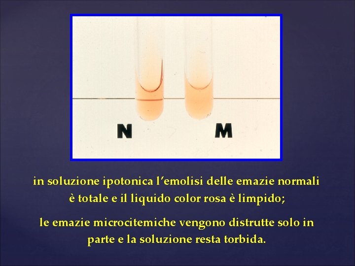in soluzione ipotonica l’emolisi delle emazie normali è totale e il liquido color rosa