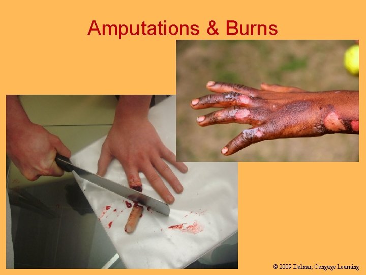 Amputations & Burns © 2009 Delmar, Cengage Learning 