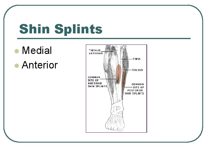 Shin Splints Medial l Anterior l Shin Splints Medial l Anterior l