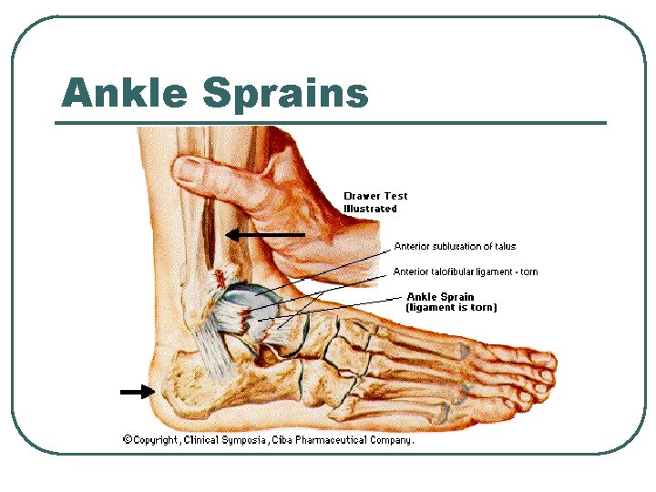 Ankle Sprains Ankle Sprains