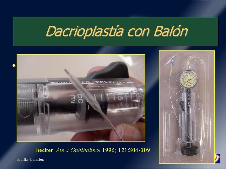 Dacrioplastía con Balón • Dr. Bruce Becker (Lacricath) Becker: Am J Ophthalmol 1996; 121: