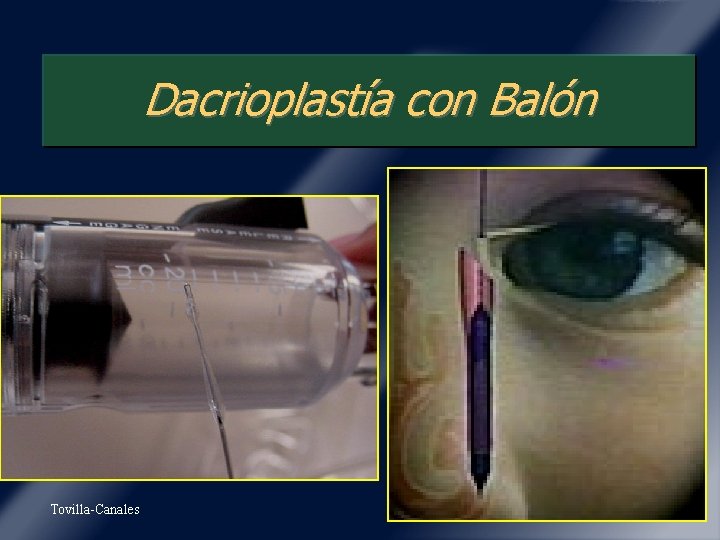 Dacrioplastía con Balón Tovilla-Canales 