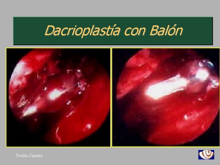 Dacrioplastía con Balón Tovilla-Canales 