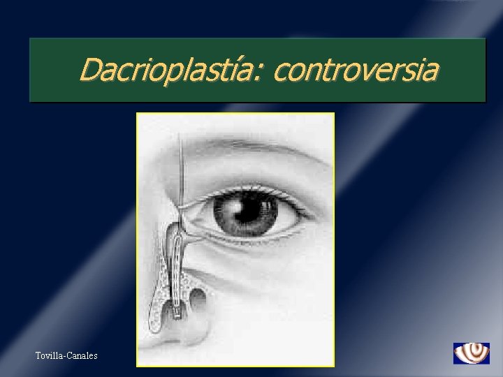 Dacrioplastía: controversia Tovilla-Canales 
