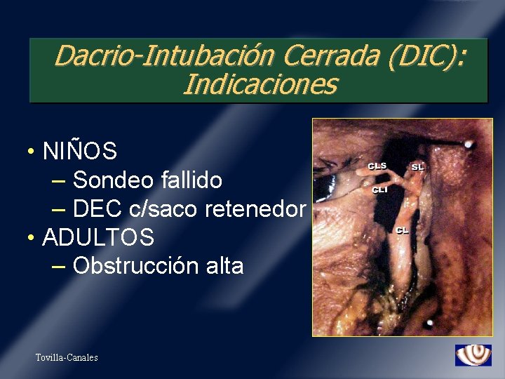 Dacrio-Intubación Cerrada (DIC): Indicaciones • NIÑOS – Sondeo fallido – DEC c/saco retenedor •