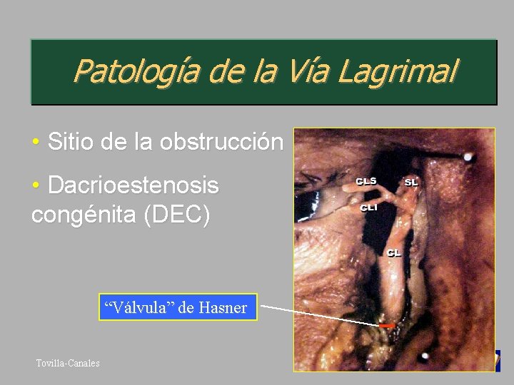Patología de la Vía Lagrimal • Sitio de la obstrucción • Dacrioestenosis congénita (DEC)